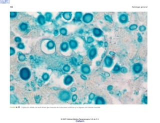 104 Patología general
FIGURA 6-23. Criptococo teñido con azul alciano que muestra las estructuras esféricas y la cápsula con material mucoide.
© 2007 Editorial Médica Panamericana, S.A de C.V.
Cisfarm
 