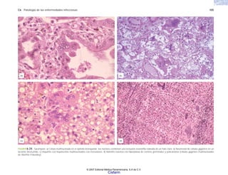 C6 Patología de las enfermedades infecciosas 105
FIGURA 6-24. Sarampión. a) Célula multinucleada en el epitelio bronquiolar; los núcleos contienen una inclusión eosinófila rodeada de un halo claro. b) Neumonía de células gigantes en un
lactante desnutrido. c) Hepatitis con hepatocitos multinucleados con inclusiones. d) Adenitis reactiva con hiperplasia de centros germinales y policariones (células gigantes multinucleadas
de Warthin Finkeldey).
(c)
(a)
(d)
(b)
© 2007 Editorial Médica Panamericana, S.A de C.V.
Cisfarm
 