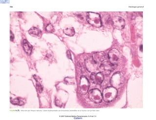 106 Patología general
FIGURA 6-25. lnfección por Herpes naricela. Célula multinucleada con inclusiones eosinófilas en el núcleo con un halo claro.
© 2007 Editorial Médica Panamericana, S.A de C.V.
Cisfarm
 