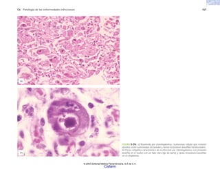 C6 Patología de las enfermedades infecciosas 107
FIGURA 6-26. a) Neumonía por citomegalovirus: numerosas células que revisten
alveolos están aumentadas de tamaño y tienen inclusiones basófilas intranucleares.
b) Efecto citopático característico de la infección por citomegalovirus con inclusión
basófila en el núcleo con un halo claro (ojo de búho) y varias inclusiones basófilas
en el citoplasma.
(b)
(a)
© 2007 Editorial Médica Panamericana, S.A de C.V.
Cisfarm
 