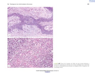 C6 Patología de las enfermedades infecciosas 109
FIGURA 6-28. Timo de un lactante con SIDA con muy escasos linfocitos y
ausencia de corpúsculos de Hassall con la misma morfología que la observada
en casos de inmunodeficiencias primarias con displasia tímica. Compárese con
la histología normal.
(a)
(b)
© 2007 Editorial Médica Panamericana, S.A de C.V.
Cisfarm
 