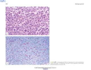 110 Patología general
FIGURA 6-29. a) Adenopatía del SIDA con hiperplasia de centros germinales y
células binucleadas. b) Proliferación vascular de vasos pequeños y ramificados.
Inmunohistoquímica con factor VIII.
(b)
(a)
© 2007 Editorial Médica Panamericana, S.A de C.V.
Cisfarm
 