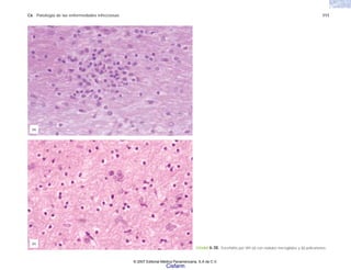 C6 Patología de las enfermedades infecciosas 111
FIGURA 6-30. Encefalitis por VIH (a) con nódulos microgliales y (b) policariones.
(b)
(a)
© 2007 Editorial Médica Panamericana, S.A de C.V.
Cisfarm
 