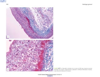 112 Patología general
FIGURA 6-31. a) Vasculitis coronaria en un caso de SIDA que muestra necrosis
fibrinoide de la pared, engrosamiento endotelial e infiltrado inflamatorio mononu-
clear (tinción de Masson). b) Inserto.
(b)
(a)
© 2007 Editorial Médica Panamericana, S.A de C.V.
Cisfarm
 