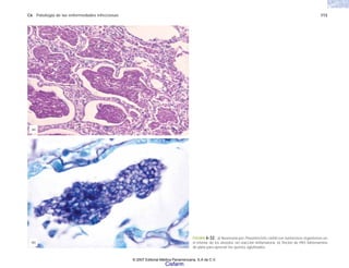 C6 Patología de las enfermedades infecciosas 113
FIGURA 6-32. a) Neumonía por Pneumocistis carinii con numerosos organismos en
el interior de los alveolos sin reacción iinflamatoria. b) Tinción de PAS Metenamina
de plata para apreciar los quistes aglutinados.
(b)
(a)
© 2007 Editorial Médica Panamericana, S.A de C.V.
Cisfarm
 