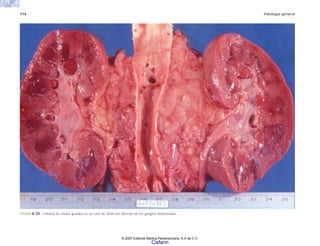 114 Patología general
FIGURA 6-33. Linfoma de células grandes en un caso de SIDA con afección de los ganglios abdominales.
© 2007 Editorial Médica Panamericana, S.A de C.V.
Cisfarm
 