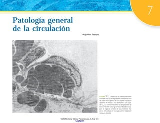 7
Patología general
de la circulación
Ruy Pérez Tamayo
Patología general
de la circulación
FIGURA 7-1. Lesión de la célula endotelial
causada por O2 en el pulmón. Ultraestructura
de parte de la pared de un capilar expuesto
durante 48 horas a una atmósfera con 73%
de O2. La célula endotelial se desprendió de
la membrana basal y varios eritrocitos ocu-
pan el espacio creado de esa manera; hay
otros eritrocitos en el espacio intersticial del
tabique alveolar.
© 2007 Editorial Médica Panamericana, S.A de C.V.
Cisfarm
 