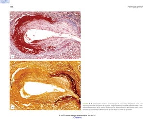 122 Patología general
FIGURA 7-2. Poliarteritis nodosa. a) Histología de una arteria interlobar renal, con
necrosis fibrinoide de parte de la pared, engrosamiento irregular subendotelial e infil-
tración inflamatoria de la íntima. b) Tinción de fibras elásticas del mismo vaso (corte
seriado) que muestra la interrupción de las fibras a partir de la lesión.
(a)
(b)
© 2007 Editorial Médica Panamericana, S.A de C.V.
Cisfarm
 