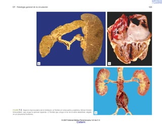 C7 Patología general de la circulación 123
FIGURA 7-3. Aspecto macroscópico de la trombosis. a) Trombo en venas porta y esplénica. b)Gran trombo
intracardiaco, que ocupa la aurícula izquierda. c) Trombo que ocluye la luz de la aorta abdominal, alojado
en un aneurisma fusiforme.
(c)
(a) (b)
© 2007 Editorial Médica Panamericana, S.A de C.V.
Cisfarm
 