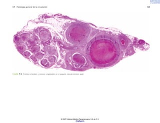 C7 Patología general de la circulación 125
FIGURA 7-5. Trombos arteriales y venosos organizados en el paquete vásculo-nervioso poplí-
© 2007 Editorial Médica Panamericana, S.A de C.V.
Cisfarm
 