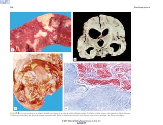 126 Patología general
FIGURA 7-6. Infartos isquémicos. a) Infartos múltiples del bazo, en un caso de endocarditis bacteriana. b) Infarto cerebral antiguo, con colapso del lóbulo temporal.
c) Infarto del miocardio, que afecta al tabique interventricular, d)Infarto antiguo del miocardio, con fibrosis extensa que sustituye a las fibras musculares.
(a)
(b)
(d)
(c)
© 2007 Editorial Médica Panamericana, S.A de C.V.
Cisfarm
 