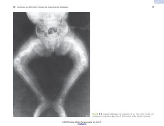C2 Lesiones en diferentes niveles de organización biológica 11
FIGURA 2-3. Aspecto radiológico del esqueleto de un niño recién nacido con
osteogénesis imperfecta grave (tipo I). (Cortesía de la Dra. Sandra Carnevale.)
© 2007 Editorial Médica Panamericana, S.A de C.V.
Cisfarm
 