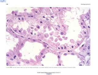 128 Patología general
FIGURA 7-8. Necrosis tubular renal en un caso de choque hemorrágico. Las células tubulares están descamadas en la luz y muchas no muestran núcleo.
© 2007 Editorial Médica Panamericana, S.A de C.V.
Cisfarm
 