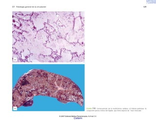 C7 Patología general de la circulación 129
FIGURA 7-9. Consecuencias de la insuficiencia cardíaca. a) Edema pulmonar. b)
Congestión pasiva crónica del hígado, que toma aspecto de “nuez moscada.”
(a)
(b)
© 2007 Editorial Médica Panamericana, S.A de C.V.
Cisfarm
 