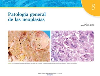 8
(b)
(a)
Patología general
de las neoplasias
Ruy Pérez Tamayo
Patricia Alonso de Ruiz
Patología general
de las neoplasias
FIGURA 8-1. Neoplasia con nombre derivado de las células que la forman. a) Hepatoma, aspecto macroscópico. b) Hepatoma, aspecto microscópico.
© 2007 Editorial Médica Panamericana, S.A de C.V.
Cisfarm
 
