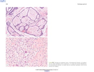 132 Patología general
FIGURA 8-2. Ejemplos de neoplasias mixtas. a) Fibroadenoma mamario, con prolifera-
ción de células epiteliales (de los conductos) y de células del estroma (fibroblastos).
b) Carcinosarcoma mamario, en donde tanto los elementos epiteliales como los del
estroma son malignos.
(a)
(b)
© 2007 Editorial Médica Panamericana, S.A de C.V.
Cisfarm
 