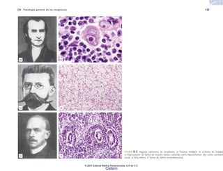 C8 Patología general de las neoplasias 133
FIGURA 8-3. Algunos epónimos de neoplasias. a) Thomas Hodgkin. b) Linfoma de Hodgkin
c) Paul Grawitz. d) Tumor de Grawitz (antes conocido como hipernefroma, hoy como carcinom
renal). e) Max Wilms. f) Tumor de Wilms (nefroblastoma).
(b)
(f)
(e)
(a)
(d)
(c)
© 2007 Editorial Médica Panamericana, S.A de C.V.
Cisfarm
 