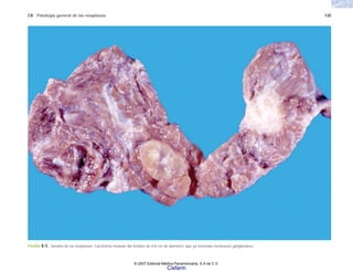 C8 Patología general de las neoplasias 135
FIGURA 8-5. Tamaño de las neoplasias. Carcinoma medular del tiroides de 0.8 cm de diámetro, que ya mostraba metástasis ganglionares.
© 2007 Editorial Médica Panamericana, S.A de C.V.
Cisfarm
 