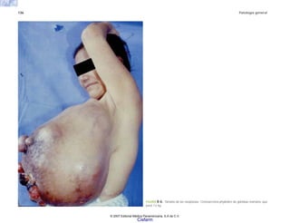 136 Patología general
FIGURA 8-6. Tamaño de las neoplasias. Cistosarcoma phyllodes de glándula mamaria, que
pesó 12 kg.
© 2007 Editorial Médica Panamericana, S.A de C.V.
Cisfarm
 