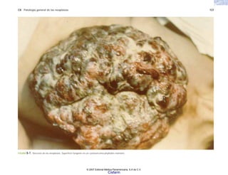 C8 Patología general de las neoplasias 137
FIGURA 8-7. Necrosis de las neoplasias. Superficie fungante en un cystosarcoma phyllodes mamario.
© 2007 Editorial Médica Panamericana, S.A de C.V.
Cisfarm
 