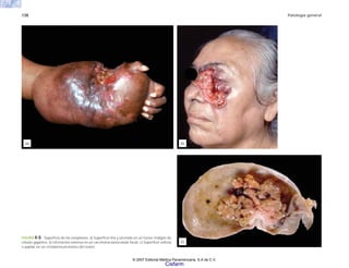 138 Patología general
FIGURA 8-8. Superficie de las neoplasias. a) Superficie lisa y ulcerada en un tumor maligno de
células gigantes. b) Ulceración extensa en un carcinoma basocelular facial. c) Superficie vellosa
o papilar en un cistadenocarcinoma del ovario.
(c)
(b)
(a)
© 2007 Editorial Médica Panamericana, S.A de C.V.
Cisfarm
 