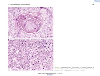 C8 Patología general de las neoplasias 139
FIGURA 8-9. Diferenciación celular en los tumores. a) Carcinoma epidermoide de
piel con formación de queratina. b) Adenocarcinoma de colon poco diferenciado, con
células en anillo de sello que producen moco pero no lo secretan.
(b)
(a)
© 2007 Editorial Médica Panamericana, S.A de C.V.
Cisfarm
 