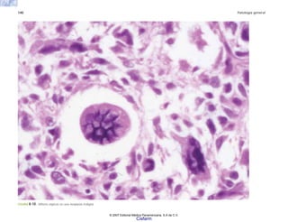 140 Patología general
FIGURA 8-10. Mitosis atípicas en una neoplasia maligna.
© 2007 Editorial Médica Panamericana, S.A de C.V.
Cisfarm
 