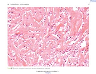 C8 Patología general de las neoplasias 141
FIGURA 8-11. Reacción desmoplástica intensa en un carcinoma poco diferenciado de la mama.
© 2007 Editorial Médica Panamericana, S.A de C.V.
Cisfarm
 