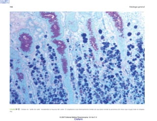 142 Patología general
FIGURA 8-12. Células en “anillo de sello” invadiendo la mucosa del colon. El citoplasma está intensamente teñido de azul para revelar la presencia de moco que ocupa todo el citoplas-
ma.
© 2007 Editorial Médica Panamericana, S.A de C.V.
Cisfarm
 