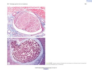 C8 Patología general de las neoplasias 143
FIGURA 8-13. Invasión vascular. a) Invasión de una vena por un carcinoma renal. b) Invasión de
una vena intrahepática por un hepatoma.
(b)
(a)
© 2007 Editorial Médica Panamericana, S.A de C.V.
Cisfarm
 