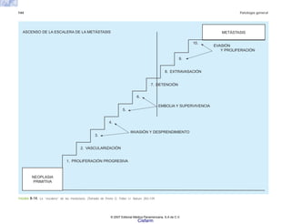 144 Patología general
FIGURA 8-14. La “escalera” de las metástasis. (Tomado de Poste G, Fidier IJ. Nature 283:139.
NEOPLASIA
PRIMITIVA
METÁSTASIS
ASCENSO DE LA ESCALERA DE LA METÁSTASIS
10.
9.
8. EXTRAVASACIÓN
EVASIÓN
Y PROLIFERACIÓN
7. DETENCIÓN
6.
5.
4.
3.
2. VASCULARIZACIÓN
1. PROLIFERACIÓN PROGRESIVA
INVASIÓN Y DESPRENDIMIENTO
EMBOLIA Y SUPERVIVENCIA
© 2007 Editorial Médica Panamericana, S.A de C.V.
Cisfarm
 