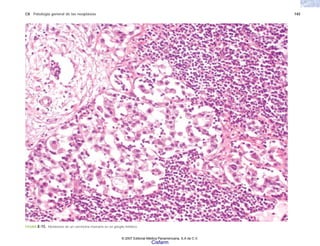 C8 Patología general de las neoplasias 145
FIGURA 8-15. Metástasis de un carcinoma mamario en un ganglio linfático.
© 2007 Editorial Médica Panamericana, S.A de C.V.
Cisfarm
 