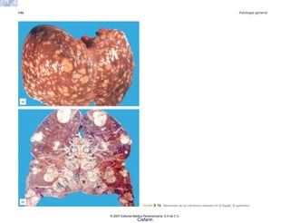 146 Patología general
FIGURA 8-16. Metástasis de un carcinoma mamario en a) hígado, b) pulmones.
(b)
(a)
© 2007 Editorial Médica Panamericana, S.A de C.V.
Cisfarm
 