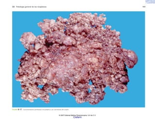 C8 Patología general de las neoplasias 147
FIGURA 8-17. Carcinomatosis peritoneal secundaria a un carcinoma del ovario.
© 2007 Editorial Médica Panamericana, S.A de C.V.
Cisfarm
 