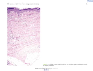 C2 Lesiones en diferentes niveles de organización biológica 13
FIGURA 2-5. Histología de la piel en la esclerodermia, con abundante colágena por debajo del nivel de
las glándulas sudoríparas.
© 2007 Editorial Médica Panamericana, S.A de C.V.
Cisfarm
 