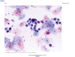 148 Patología general
FIGURA 8-18. Citología exfoliativa. Carcinoma epidermoide in situ. Tinción de Papanicolaou.
© 2007 Editorial Médica Panamericana, S.A de C.V.
Cisfarm
 