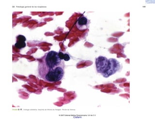 C8 Patología general de las neoplasias 149
FIGURA 8-19. Citología exfoliativa. Impronta de linfoma de Hodgkin. Tinción de Giemsa.
© 2007 Editorial Médica Panamericana, S.A de C.V.
Cisfarm
 