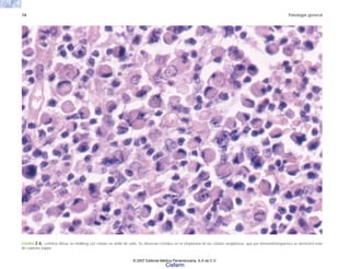 14 Patología general
FIGURA 2-6. Linfoma difuso no Hodking con células en anillo de sello. Se observan cristales en el citoplasma de las células neoplásicas, que por inmunohistoquímica se demostró eran
de cadenas kappa.
© 2007 Editorial Médica Panamericana, S.A de C.V.
Cisfarm
 