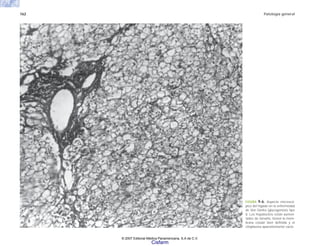 162 Patología general
FIGURA 9-6. Aspecto microscó-
pico del hígado en la enfermedad
de Von Gierke (glucogenosis tipo
I). Los hepatocitos están aumen-
tados de tamaño, tienen la mem-
brana celular bien definida y el
citoplasma aparentemente vacío.
© 2007 Editorial Médica Panamericana, S.A de C.V.
Cisfarm
 