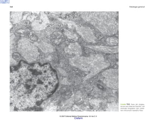 164 Patología general
FIGURA 9-8. Parte del citoplas-
ma de una célula de Gaucher, con
vesículas irregulares que contie-
nen estructuras tubulares finas.
© 2007 Editorial Médica Panamericana, S.A de C.V.
Cisfarm
 