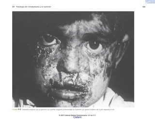 C9 Patología del metabolismo y la nutrición 165
FIGURA 9-9. Dramático aspecto de un paciente con porfiria congénita (enfermedad de Günther) con graves lesiones de la piel expuesta al sol.
© 2007 Editorial Médica Panamericana, S.A de C.V.
Cisfarm
 