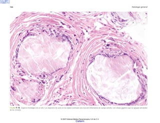 166 Patología general
FIGURA 9-10. Aspecto histológico de un tofo. Los depósitos de urato en los tejidos estimulan una reacción inflamatoria de cuerpo extraño, con células gigantes que se agrupan alrrededor
de los cristales.
© 2007 Editorial Médica Panamericana, S.A de C.V.
Cisfarm
 