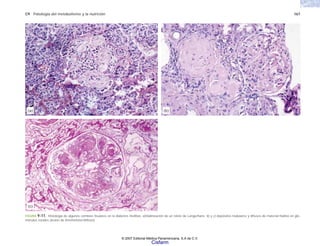 C9 Patología del metabolismo y la nutrición 167
FIGURA 9-11. Histología de algunos cambios tisulares en la diabetes mellitas. a)Hialinización de un islote de Langerhans. b) y c) depósitos nodulares y difusos de material hialino en glo-
mérulos renales (lesión de Kimmelstiel-Wilson).
(b)
(a)
(c)
© 2007 Editorial Médica Panamericana, S.A de C.V.
Cisfarm
 