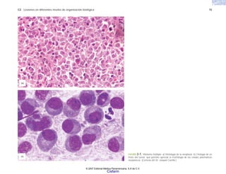 C2 Lesiones en diferentes niveles de organización biológica 15
FIGURA 2-7. Mieloma múltiple. a) Histología de la neoplasia. b) Citología de un
frotis del tumor, que permite apreciar la morfología de las células plasmáticas
neoplásicas. (Cortesía del Dr. Joaquín Carrillo.)
(a)
(b)
© 2007 Editorial Médica Panamericana, S.A de C.V.
Cisfarm
 