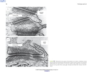 16 Patología general
FIGURA 2-8. Alteración de las uniones intercelulares en el cáncer. a) Epitelio cervical
normal unido por desmosomas (desmosome) y uniones firmes (nexus). b) Carcinoma
epidermoide del cuello uterino en el que las células están unidas por un desmoso-
ma pero no hay unión firme (wide gap). (Tomado de McNutt NS. Science 165:597.
1969.)
(b)
DESMOSOMA
UNIÓN
FIRME
(a)
DESMOSOMA
UNIONES
FIRMES
S
© 2007 Editorial Médica Panamericana, S.A de C.V.
Cisfarm
 