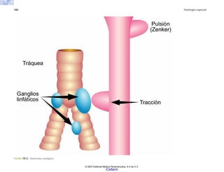 180 Patología especial
FIGURA 10-2. Divertículos esofágicos.
© 2007 Editorial Médica Panamericana, S.A de C.V.
Cisfarm
 