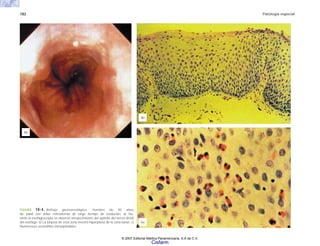 182 Patología especial
FIGURA 10-4. Reflujo gastroesofágico. Hombre de 45 años
de edad con ardor retrosternal de largo tiempo de evolución. a) Du-
rante la esofagoscopia se observó enrojecimiento del epitelio del tercio distal
del esófago. b) La biopsia de esta zona mostró hiperplasia de la zona basal. c)
Numerosos eosinófilos intraepiteliales.
(b)
(c)
(a)
© 2007 Editorial Médica Panamericana, S.A de C.V.
Cisfarm
 