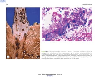 184 Patología especial
FIGURA 10-6. Esofagitis herpética. Este espécimen se obtuvo en la autopsia de un hombre de 32 años de
edad que recibió un trasplante renal cinco años antes, por lo que fue necesario administrar medicamentos
inmunosupresores para evitar el rechazo. Poco antes de morir desarrolló dolor retrosternal intenso. a) En la
autopsia se encontraron múltiples lesiones eritematobulosas en el tercio distal del esófago y proximal del
estómago. b) El examen microscópico demostró múltiples células epiteliales con núcleos claros en “vidrio
esmerilado” e inclusiones intranucleares típicas de infección por virus del Herpes.
(b)
(a)
© 2007 Editorial Médica Panamericana, S.A de C.V.
Cisfarm
 
