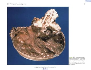 C10 Patología del aparato digestivo 185
FIGURA 10-7. Adenocarcinoma de la
unión cardioesofágica. Este tumor,
como el originado en el cardias, com-
parte características epidemiológicas
y clínicas muy parecidas con el adeno-
carcinoma esofágico asociado a esófa-
go de Barrett.
© 2007 Editorial Médica Panamericana, S.A de C.V.
Cisfarm
 