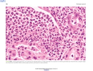 186 Patología especial
FIGURA 10-8. Gastritis aguda flegmonosa. Este espécimen fue obtenido durante el estudio endoscópico de un paciente con linfoma generalizado que desarrolló dolor y sangrado epigás-
trico. Numerosos neutrófilos infiltran la lámina propia, penetran y destruyen las células epiteliales.
© 2007 Editorial Médica Panamericana, S.A de C.V.
Cisfarm
 